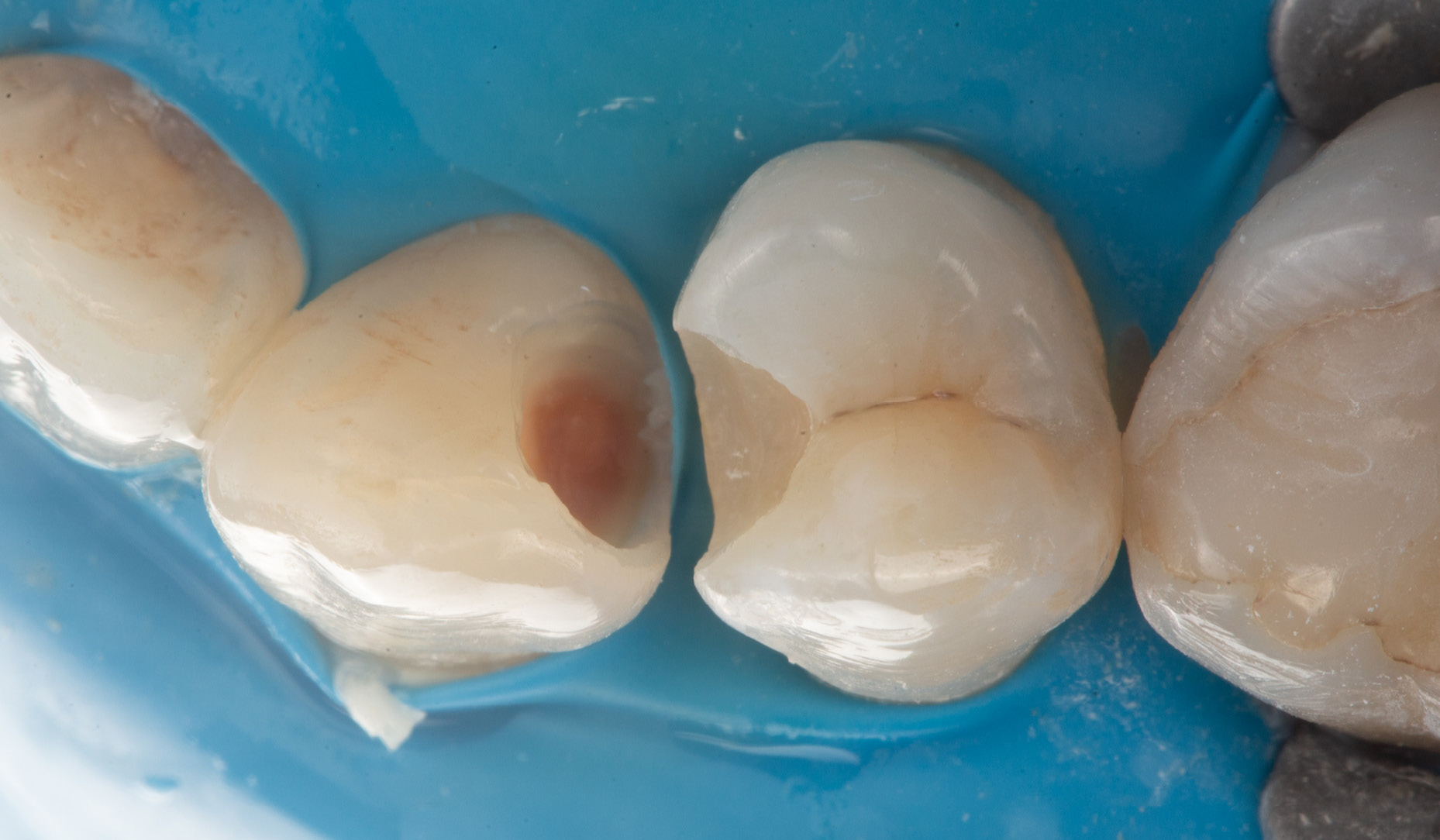 Fig. 6: Occlusal view of the teeth after deep margin elevation with universal products